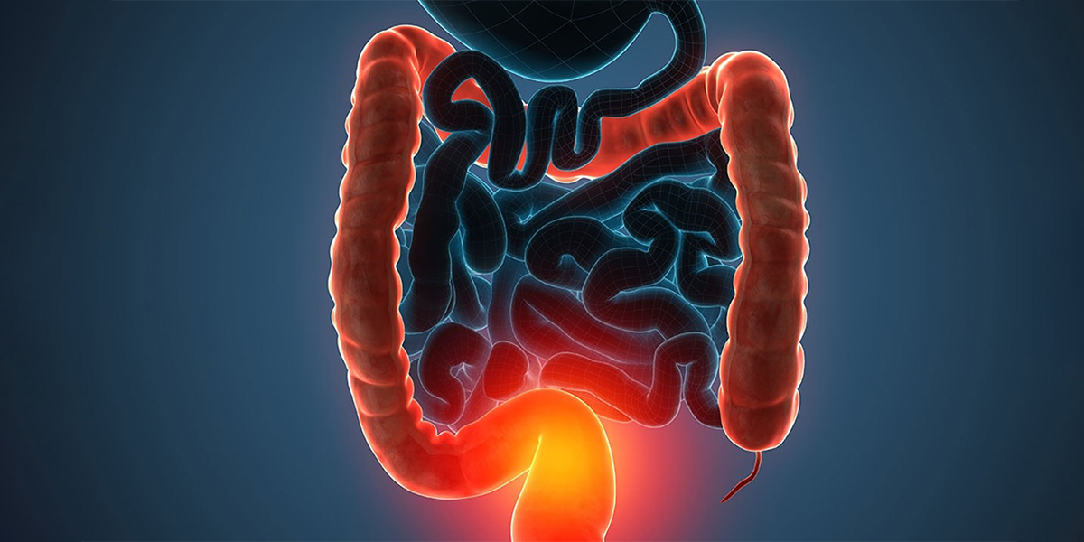 Colitis Ulcerosa