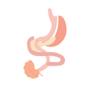 Duodenal Switch
