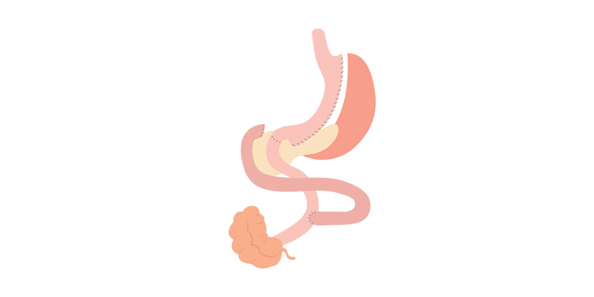 Duodenal Switch