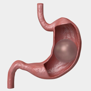Gastric Balloon