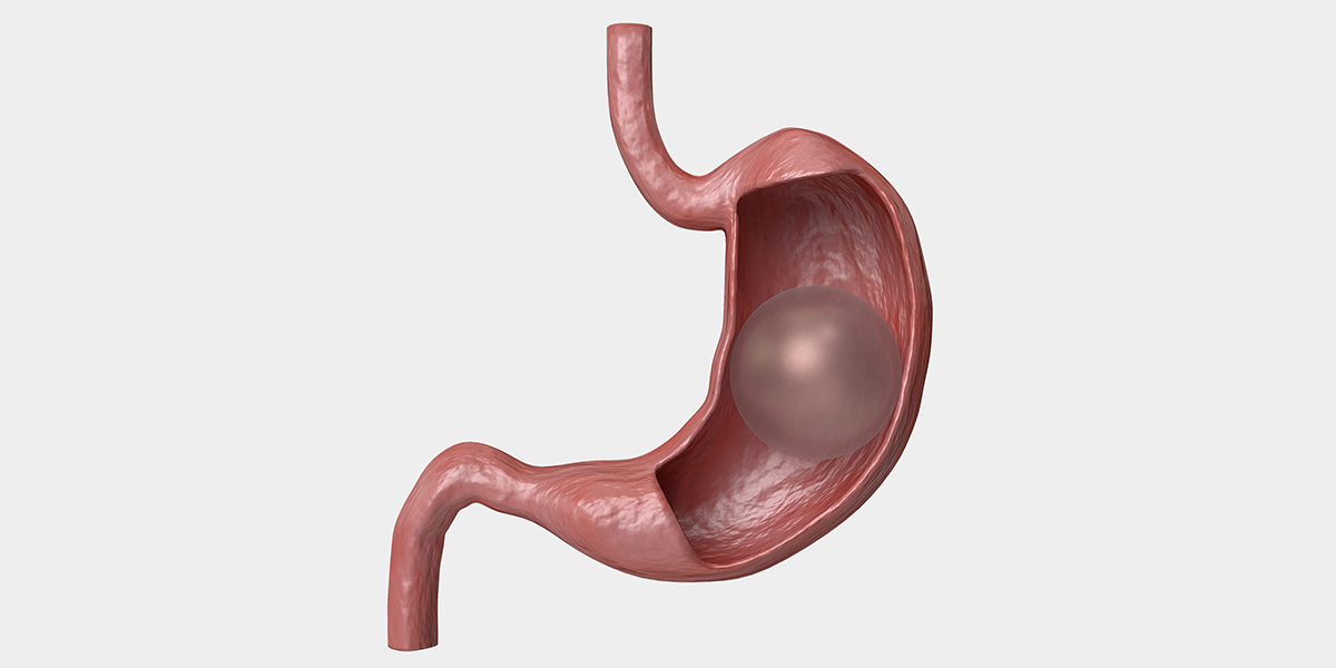 Gastric Balloon
