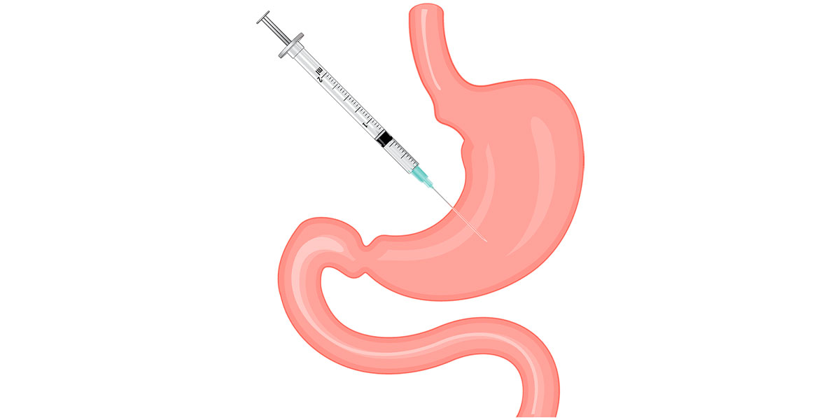 Gastric Botox