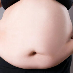 Gastric Sleeve Surgery