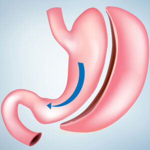 Gastric Sleeve Surgery