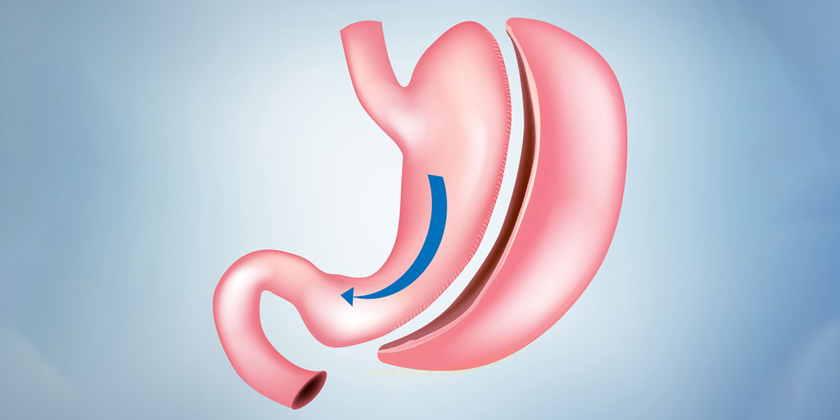 Gastric Sleeve Surgery