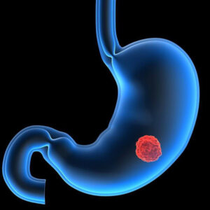 Gastric Tumor