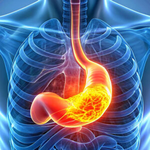 Reflux