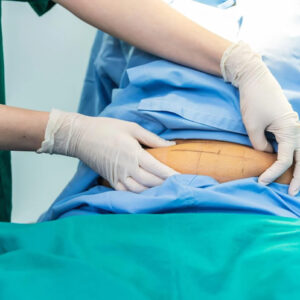 Revisional Bariatric Surgery