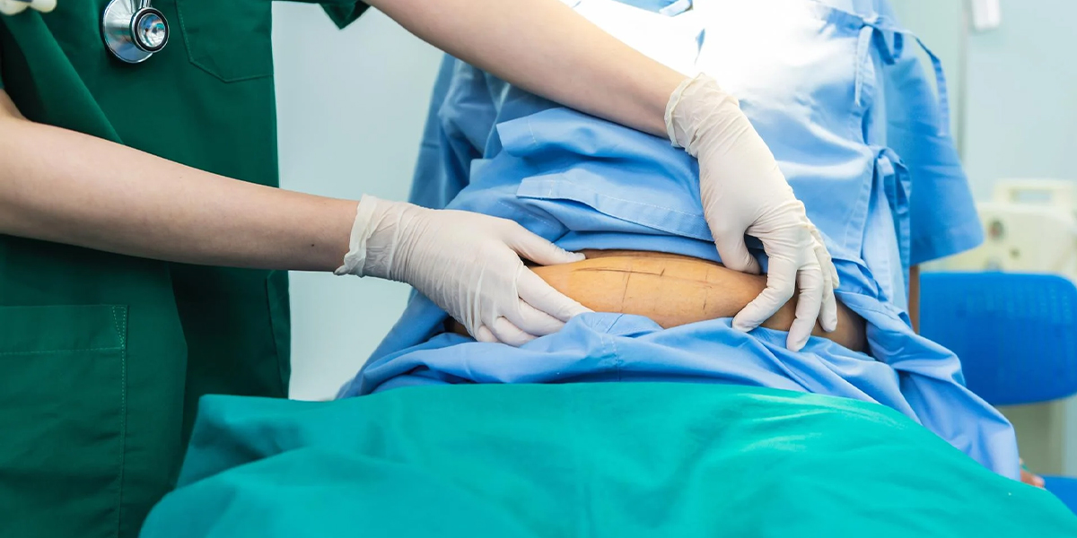 Revisional Bariatric Surgery
