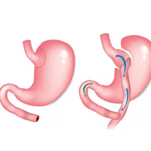 Stomach Bypass
