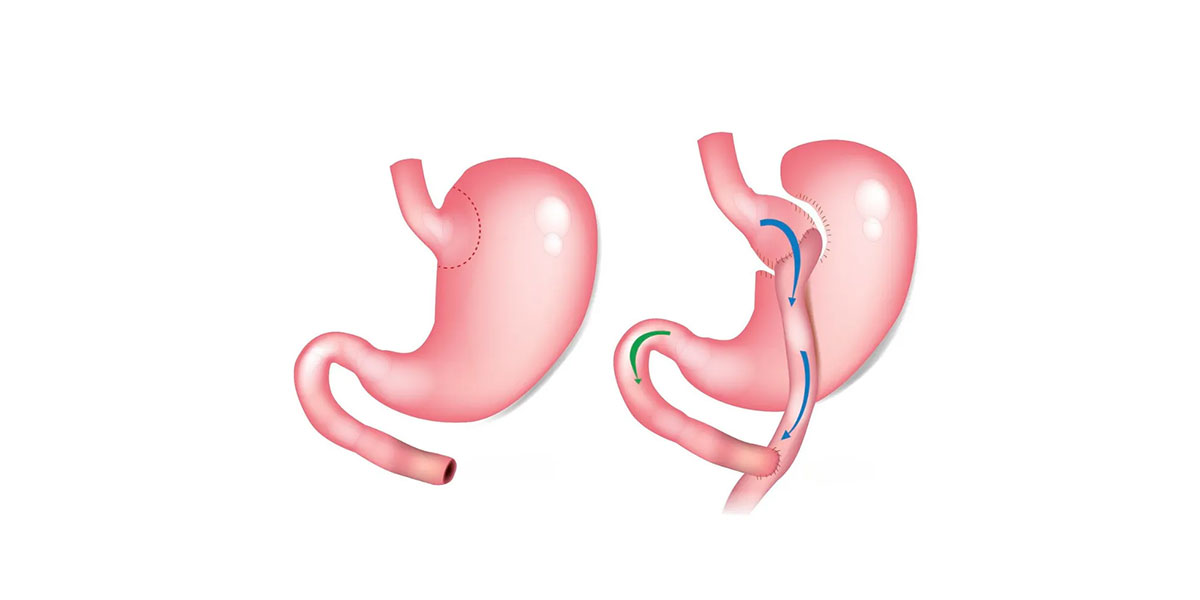 Stomach Bypass