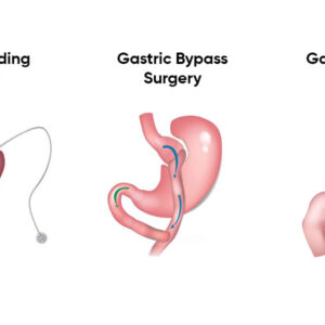 Stomach Reduction Surgery