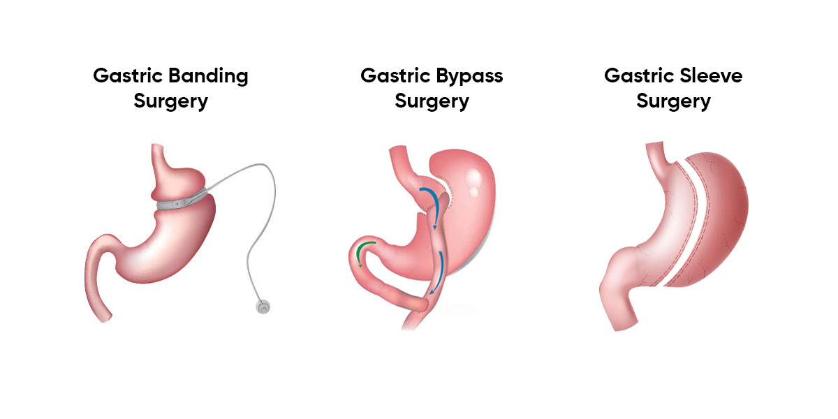 Stomach Reduction Surgery