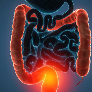 Surgeries for Ulcerative Colitis