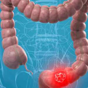 Colon (Bowel) Cancer Treatment