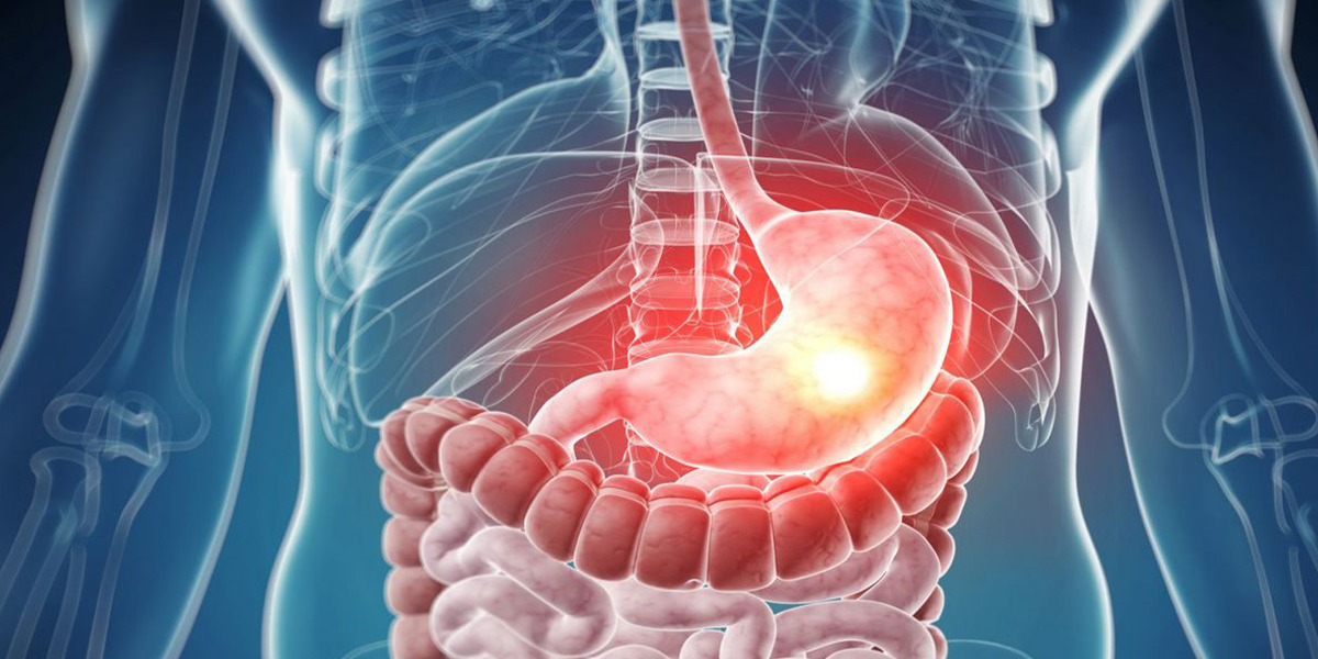 Mide Fıtığı (Hiatal Herni) Nedir?